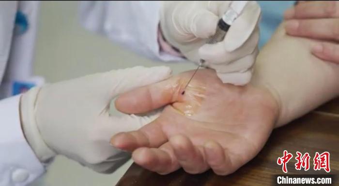 嘉善群眾體驗(yàn)小針刀?！〖紊平y(tǒng)戰(zhàn) 供圖